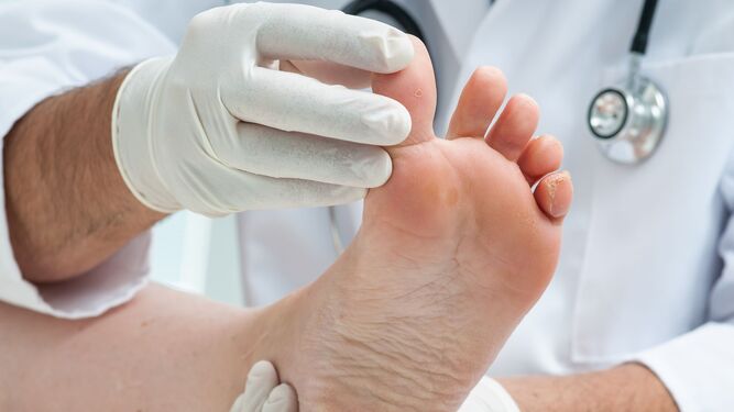 Es un tipo de artritis que causa dolor y rigidez en las articulaciones y suele aparecer primero en el pie.