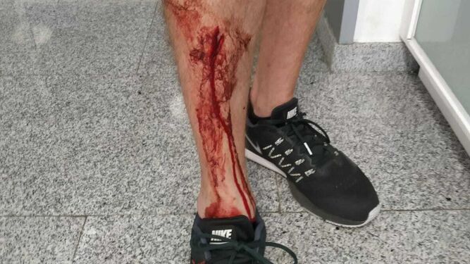 El estado en el que quedó la pierna de la víctima tras ser atropellado por el patinete