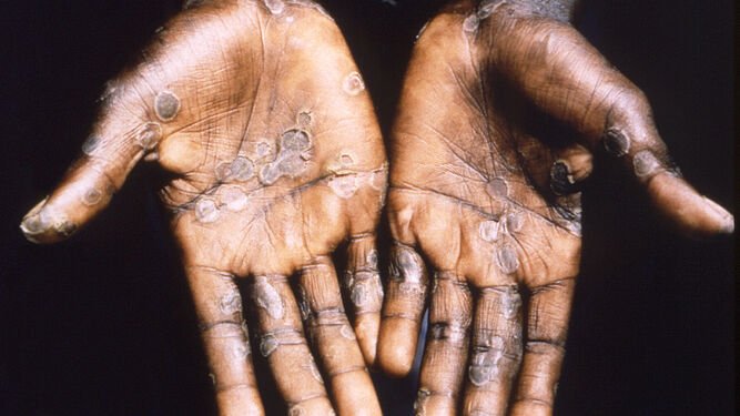 Imagen de las lesiones en la piel provocadas por la viruela  del  mono , durante un estudio llevado a cabo en la República Democrática del  Congo.