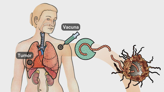 Infografía sobre cómo actúan las vacunas contra el cáncer.