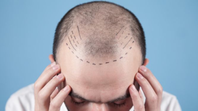 Imagen de una persona con alopecia.